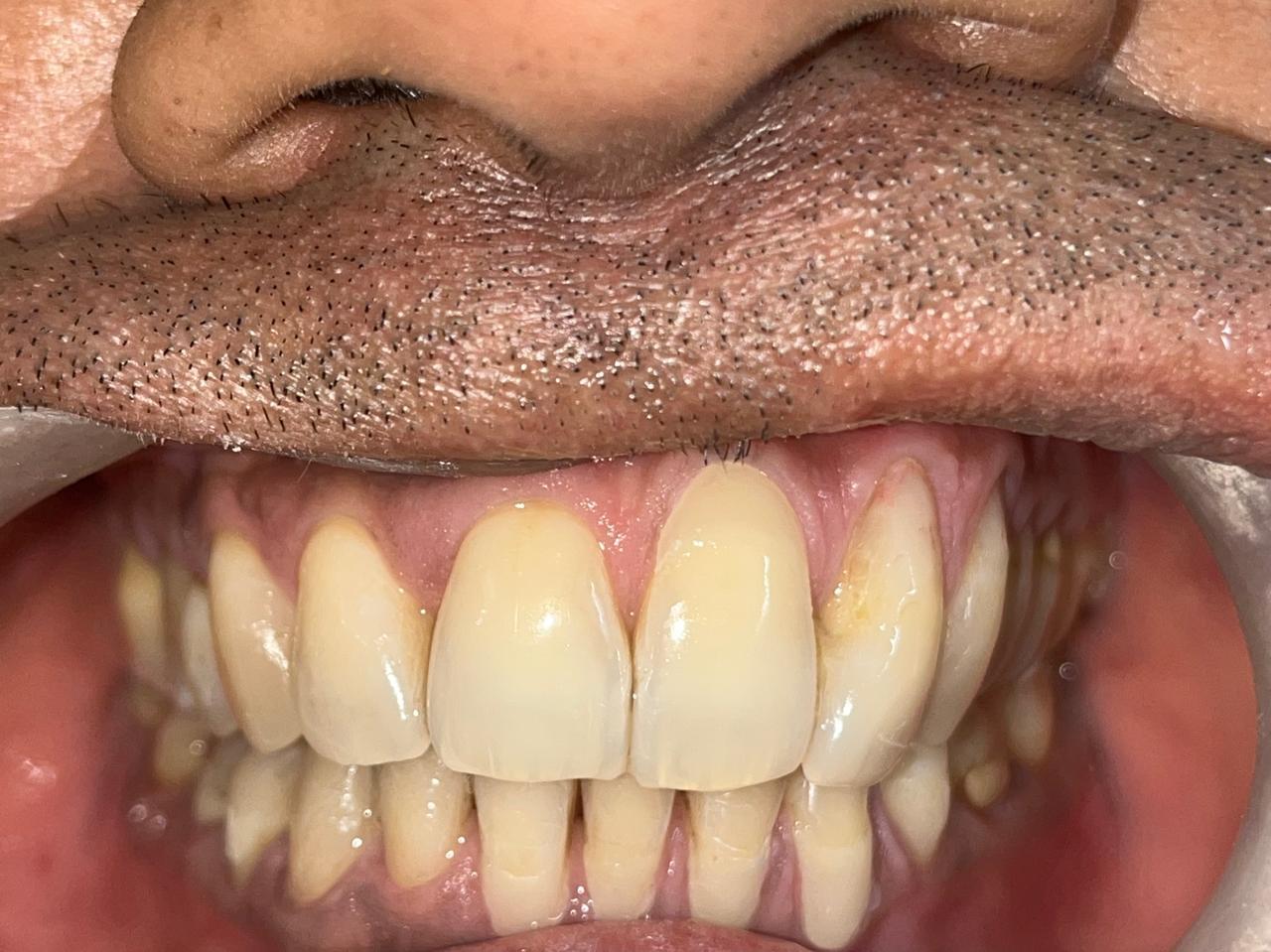 Smile transformation before and after at Sanjeevani Dental