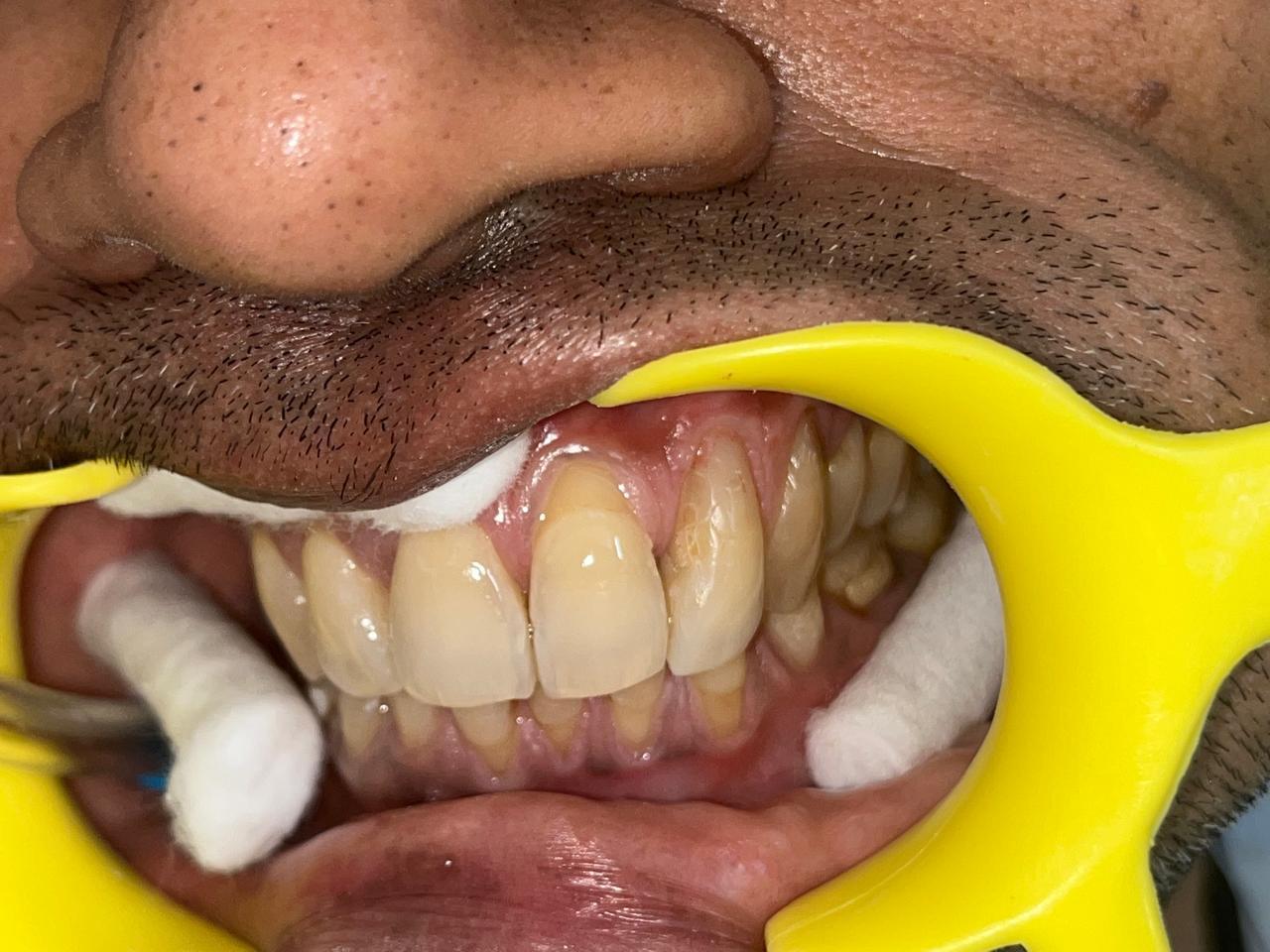 Smile transformation before and after at Sanjeevani Dental