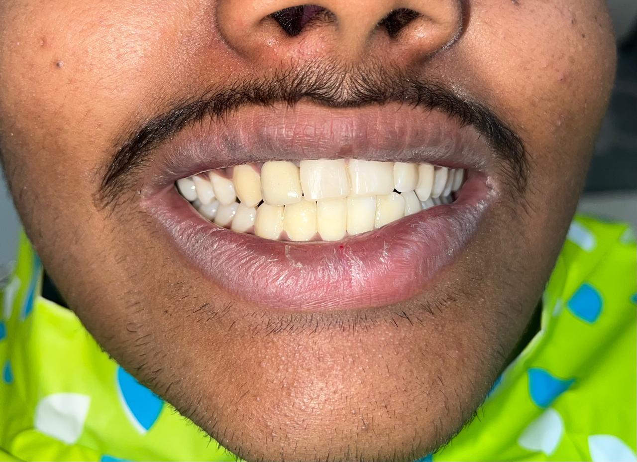 Smile transformation before and after at Sanjeevani Dental