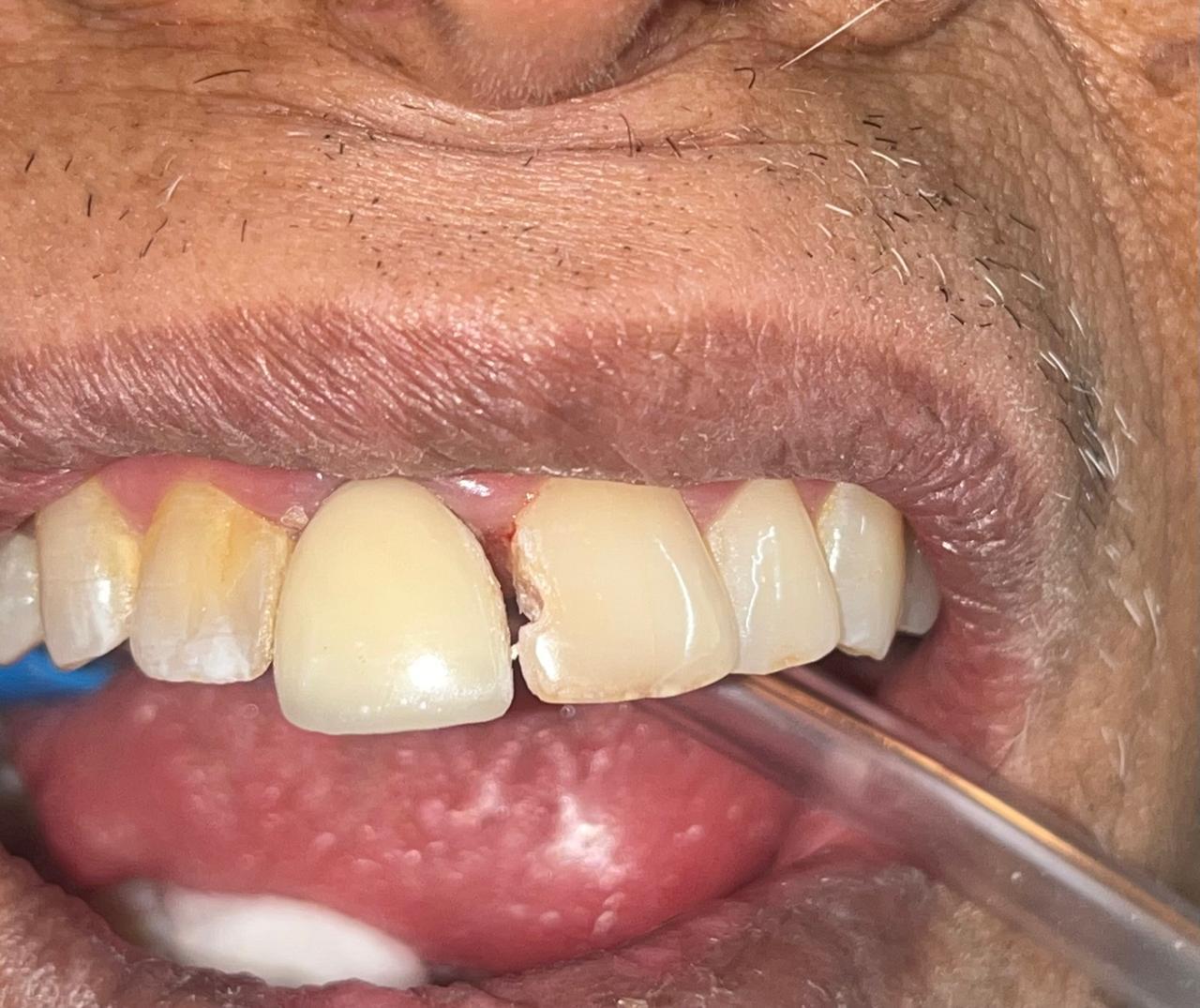 Smile transformation before and after at Sanjeevani Dental