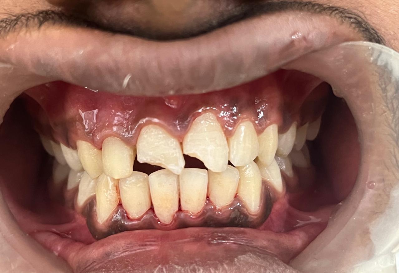 Smile transformation before and after at Sanjeevani Dental