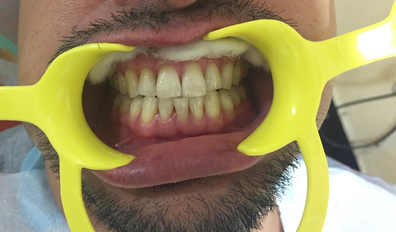 Smile transformation before and after at Sanjeevani Dental