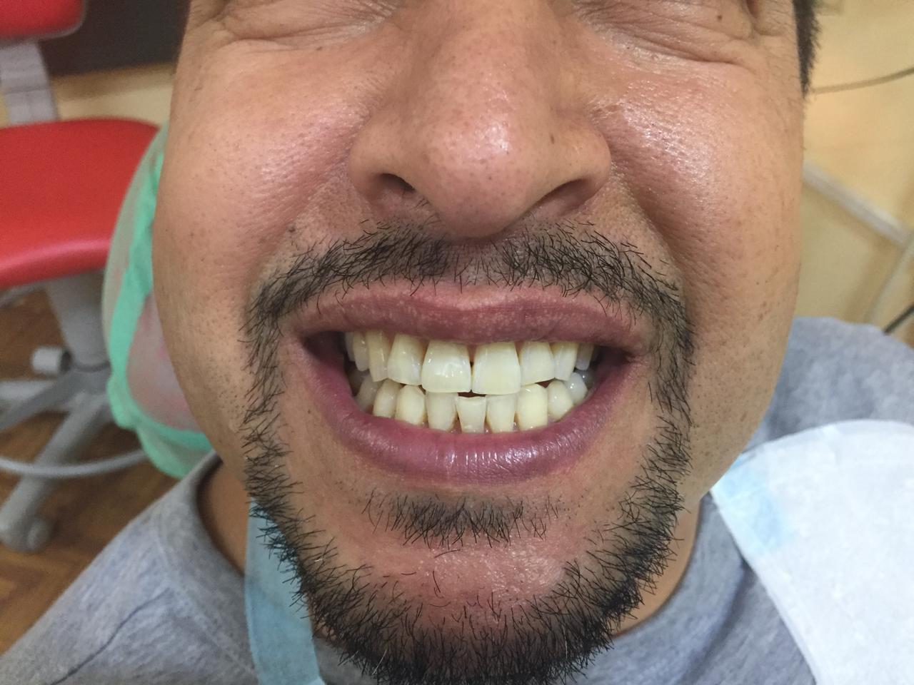 Smile transformation before and after at Sanjeevani Dental
