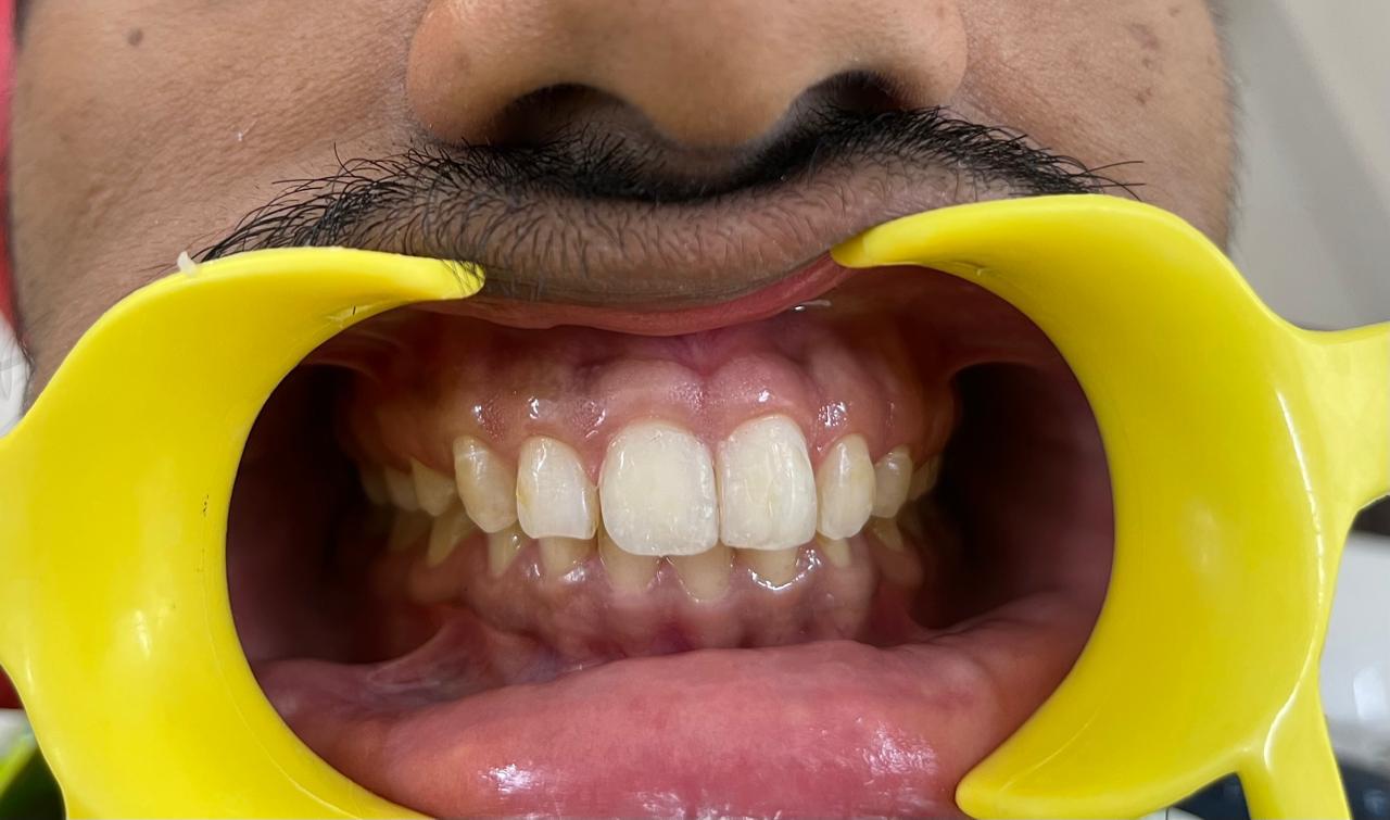 Smile transformation before and after at Sanjeevani Dental