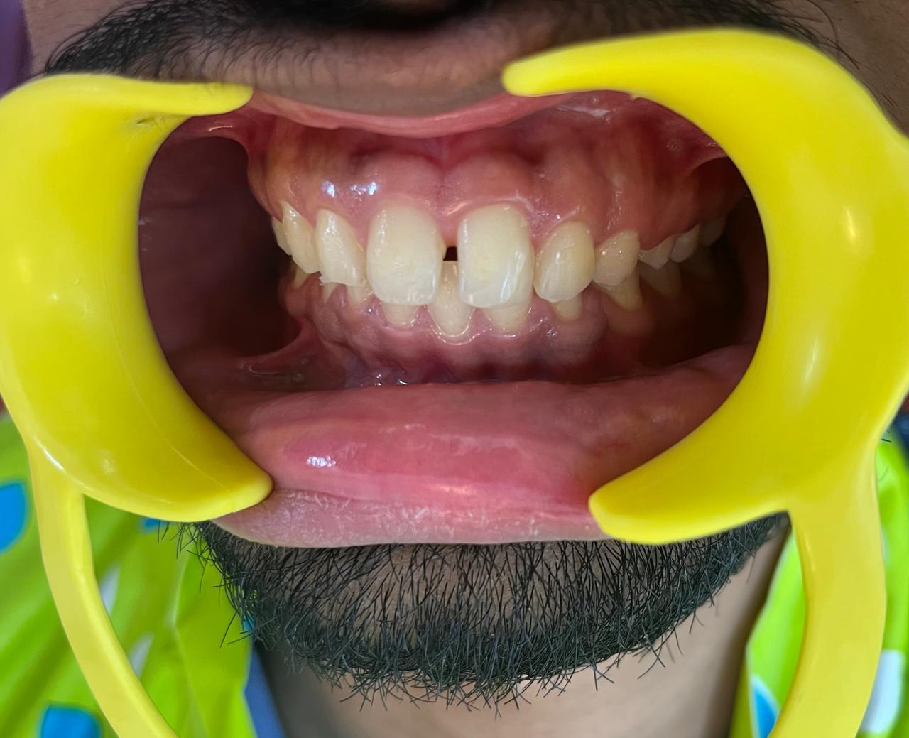 Smile transformation before and after at Sanjeevani Dental