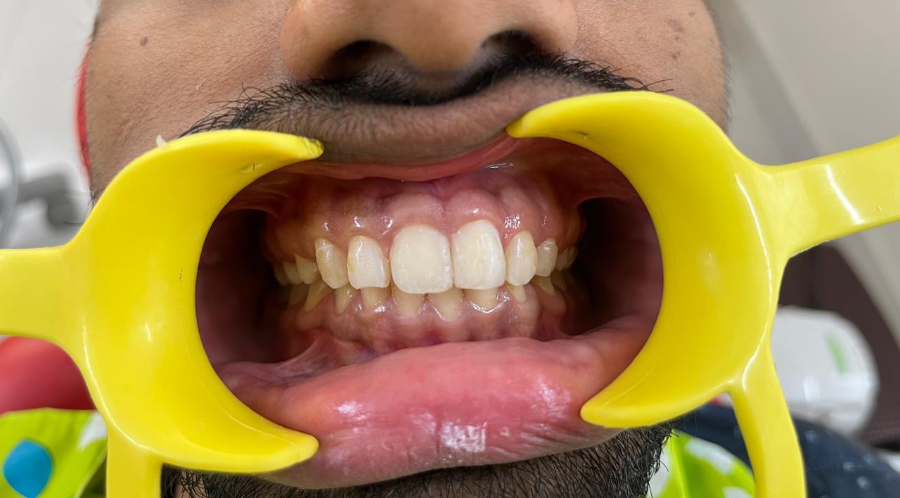 Smile transformation before and after at Sanjeevani Dental