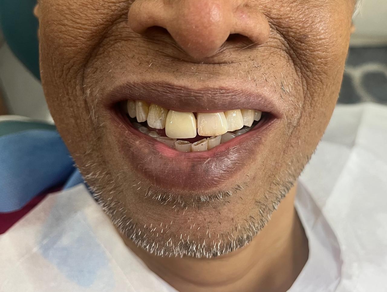 Smile transformation before and after at Sanjeevani Dental