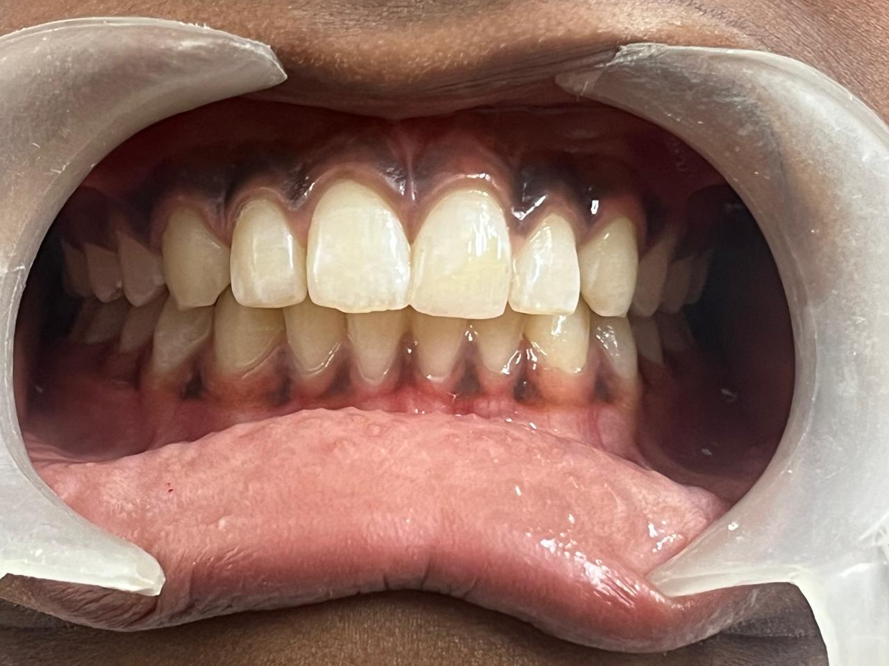 Smile transformation before and after at Sanjeevani Dental