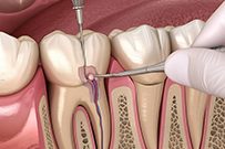 root_canal