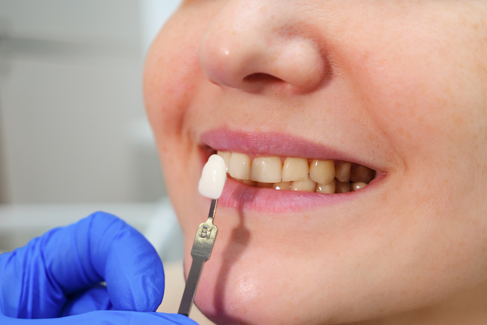 Dental implants